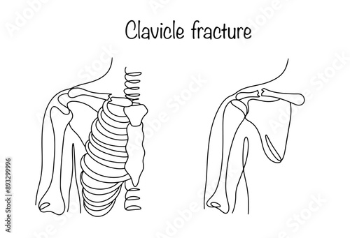 Clavicle fracture