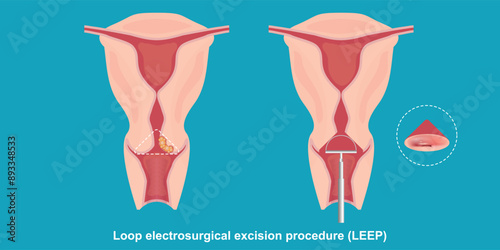 Loop electrosurgical excision procedure (LEEP) uses a wire loop heated by electric current. photo