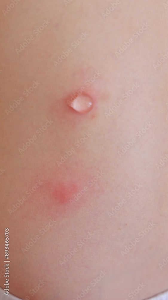 kid with lot of insects, mosquito, fleas or other parasites bites on body, back and legs.child scratches bug bites.lying baby boy toddler on pillow,covered with blanket.woman applying cream. kid with lot of insects, mosquito, fleas or other parasites bites on body, back and legs.child scratches bug bites.lying baby boy toddler on pillow,covered with blanket.woman applying cream.