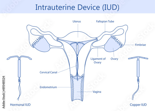 Intrauterine device or IUD.  intrauterine contraceptive device.  Vector illustration