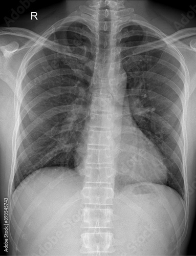 Clinical Applications of Erect PA Chest X-rays in Respiratory Medicine