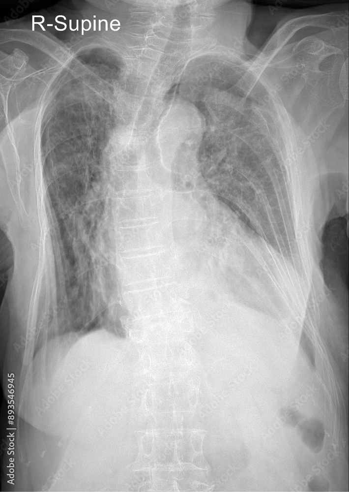 Unveiling Lung Diseases: The Role of Chest X-ray in Diagnosis Unveiling Lung Diseases: The Role of Chest X-ray in Diagnosis