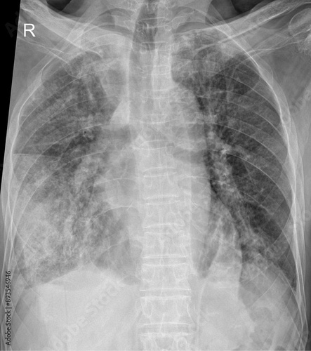 Analyzing Chest X-ray Features in Chronic Respiratory Conditions photo