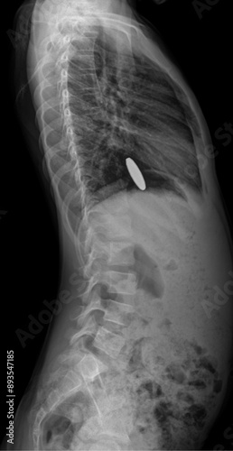 Foto child x -ray chest and abdomen lateral radiograph with foreign object