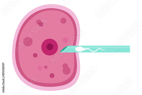 sperm and egg fertillization. In Vitro Fertillization , IVF