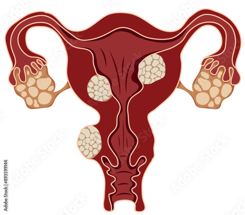 Female Reproductive Uterus Disease or Uterine Fibroid Illustration