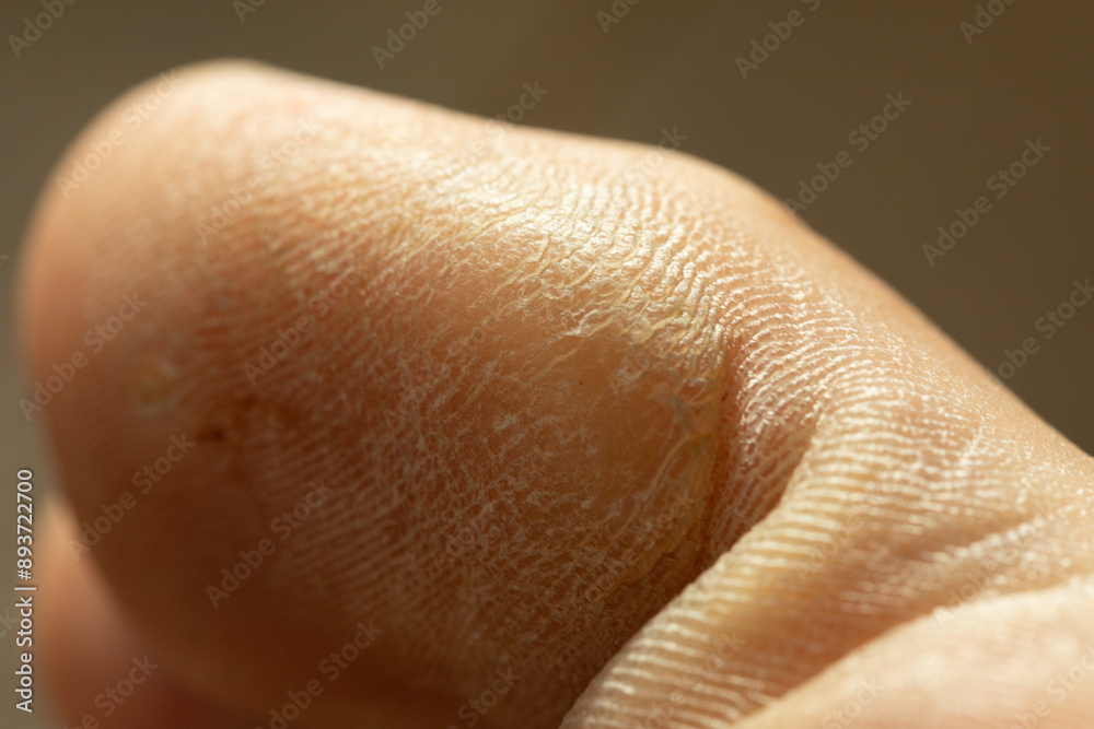 Fototapeta premium Close up of dry cracked skin on a toe