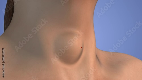 Thyroid nodule treatment medical animation