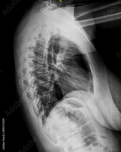 X-ray of thoracic spine. Lateral view. Vertebrae and intervertebral joints of chest. Healthy backbone anatomy radiography image.