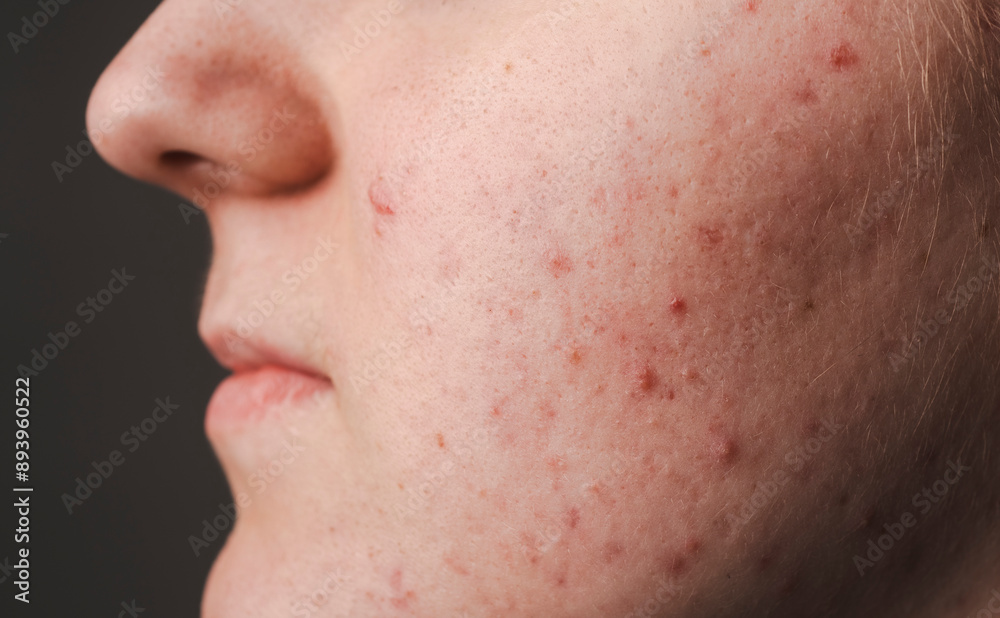 Pimple on face. Skin texture. Closeup acne skin. Treatment for skin. Problem skincare. Pimples, acne, pores, scars. Skincare concept. Acne treatment. Pimples on face. Pimple on face. Skin texture. Closeup acne skin. Treatment for skin. Problem skincare. Pimples, acne, pores, scars. Skincare concept. Acne treatment. Pimples on face.