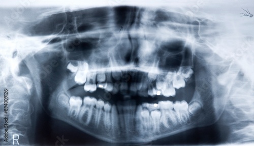 Panoramic Dental Tooth X-Ray - New Teeth Growing