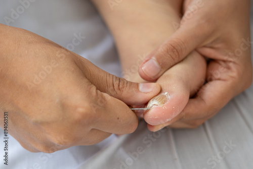 Cleaning Toenail with Onychomycosis
