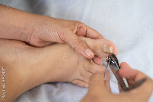 Trimming Toenail with Onychomycosis
