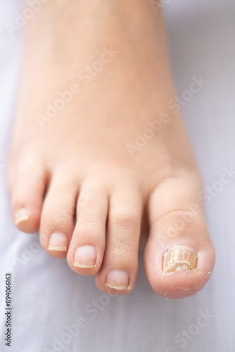 Foot with Big Toe Nail with Onychomycosis