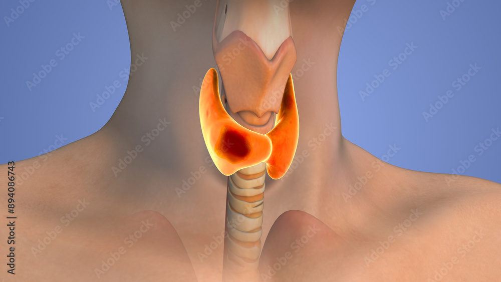 Αυτοκόλλητο Medical animation of thyroid cancer