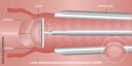 A LEEP (loop electrosurgical excision procedure).