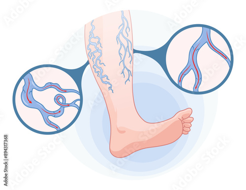 Varicose veins. Blue blood vessel visible through the skin, abnormally swollen leg. Vascular disease diagnostic and treatment. Venous insufficiency medical disease