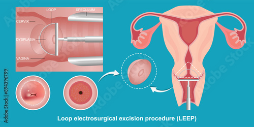 Loop electrosurgical.