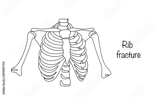 Rib fracture
