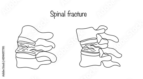 Spinal fracture