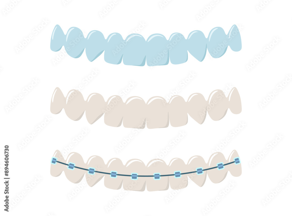 Set of dental aligners, teeth and braces illustrations. Orthodontic treatment, dental care Set of dental aligners, teeth and braces illustrations. Orthodontic treatment, dental care