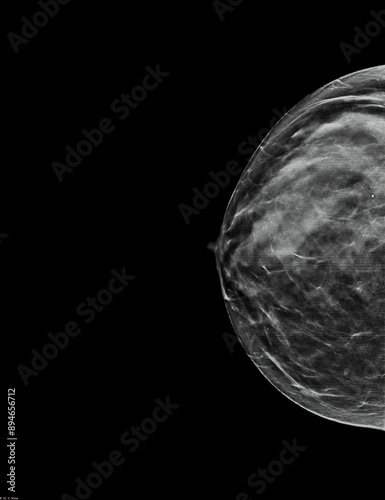 Mammogram. Right bilateral craniocaudal (CC) view (with tomosynthesis and C-view reconstruction), fibroglandular and lipomatous structure (ACR C), benign bilateral calcifications, breast cysts present photo