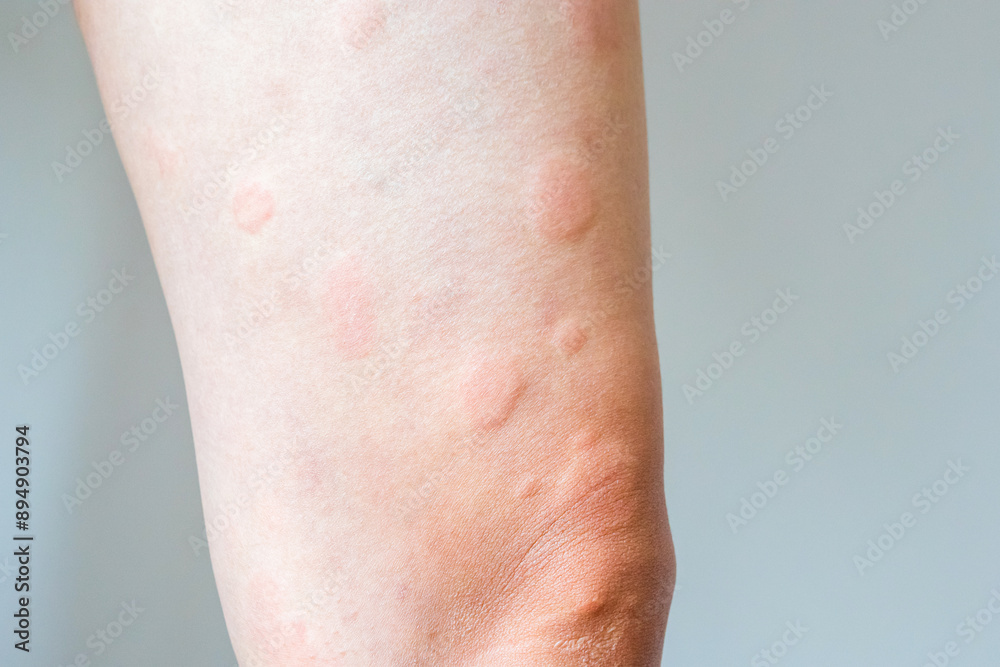 Young asian man has allergic skin rash on his legs from itchy dry skin eczema dermatitis insect bites Young asian man has allergic skin rash on his legs from itchy dry skin eczema dermatitis insect bites