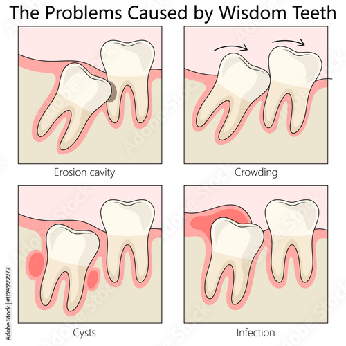 issues caused by wisdom teeth. Highlights dental problems and the need for treatment diagram hand drawn schematic vector illustration. Medical science educational illustration