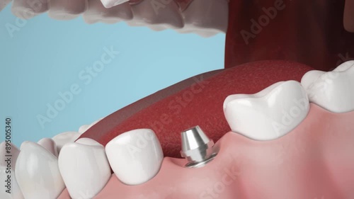 X Ray Dental Implant 3D Animation	
 photo