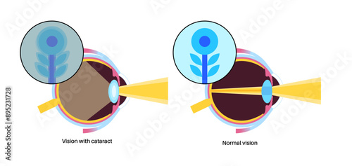 Cataract eye disease