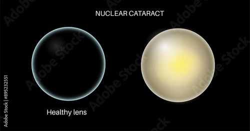 Cataract eye disease