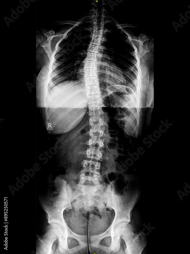 X-ray of idiopathic S-shaped scoliosis of thoracic and lumbar spine. Part of skeleton with spinal curvature on black background. Lateral backbone deformation. Radiological image of back and pelvis.