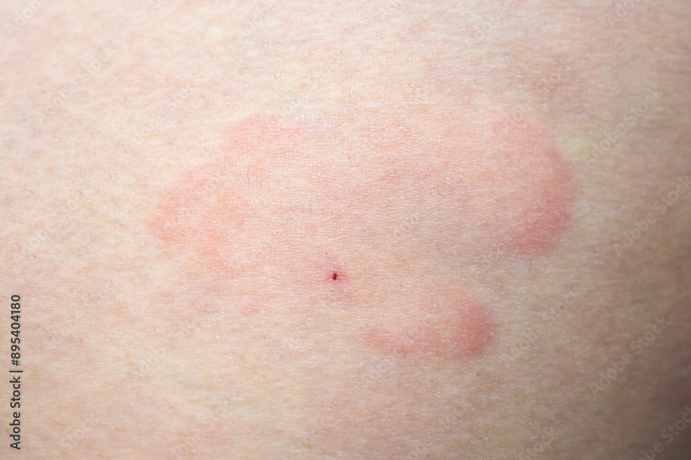 Fototapeta premium Skin allergy rash dermatitis texture close up background