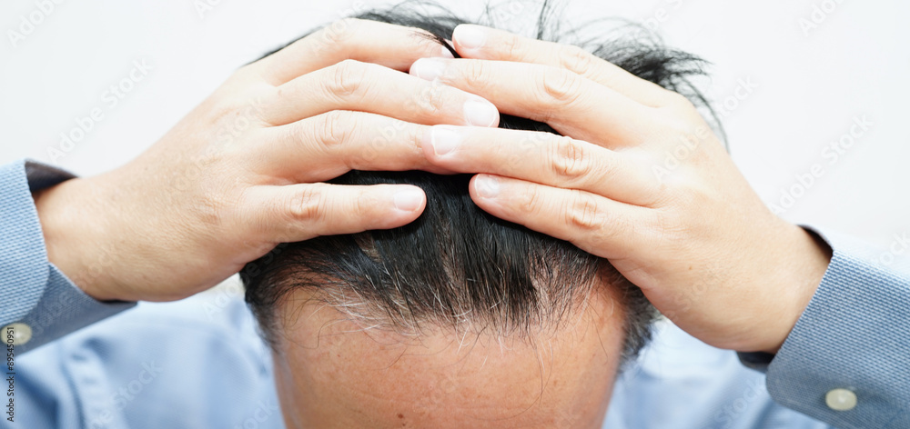 Fototapeta premium Bald head in man, hair loss treatment health problem.