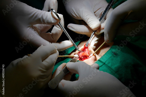 Surgeon performs open nose surgery to pull out the silicone. The doctor is sewing the rhinoplasty in the operating room.