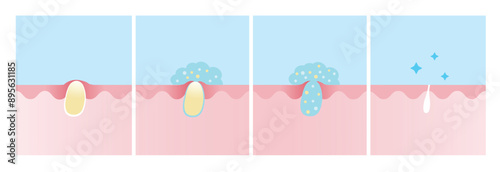 Step of acne pimple treatment process vector illustration. Apply salicylic acid on whitehead, penetrate into skin to dissolve closed plugged pore the dead skin cell, excess oil and keeping pore clear.