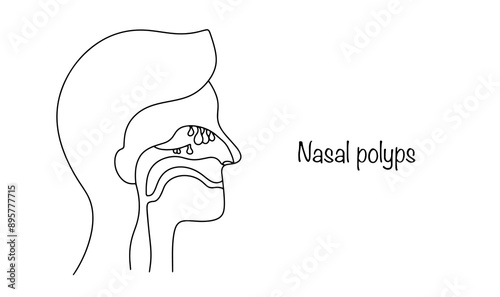 Nasal polyps