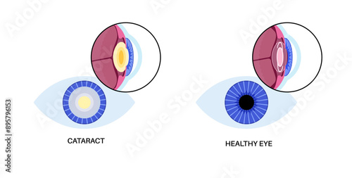 Intraocular lenses poster