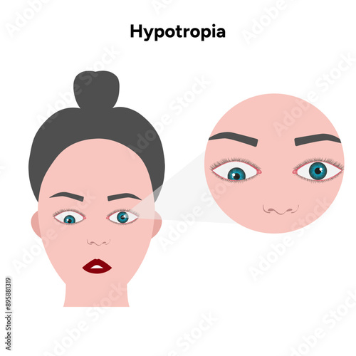 Eye problem disease strabismus Hypotropia