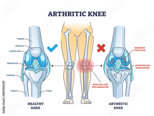 Arthritic knee or osteoarthritis and healthy bones comparison outline diagram, transparent background. Labeled educational scheme with damaged cartilage and bone spurs diagnosis illustration.