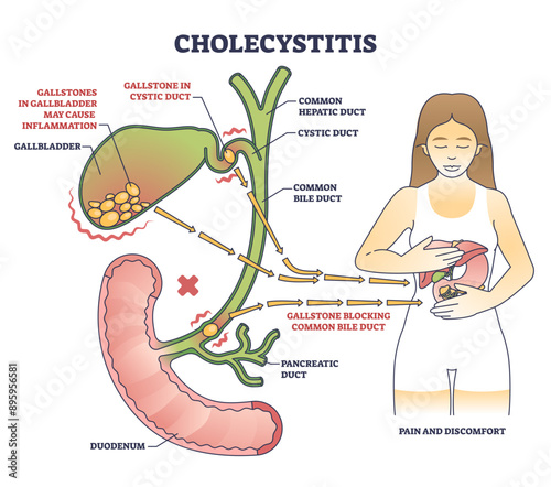 Cholecystitis as gallbladder inflammation from blocked gallbladder outline diagram, transparent background. Labeled educational scheme.