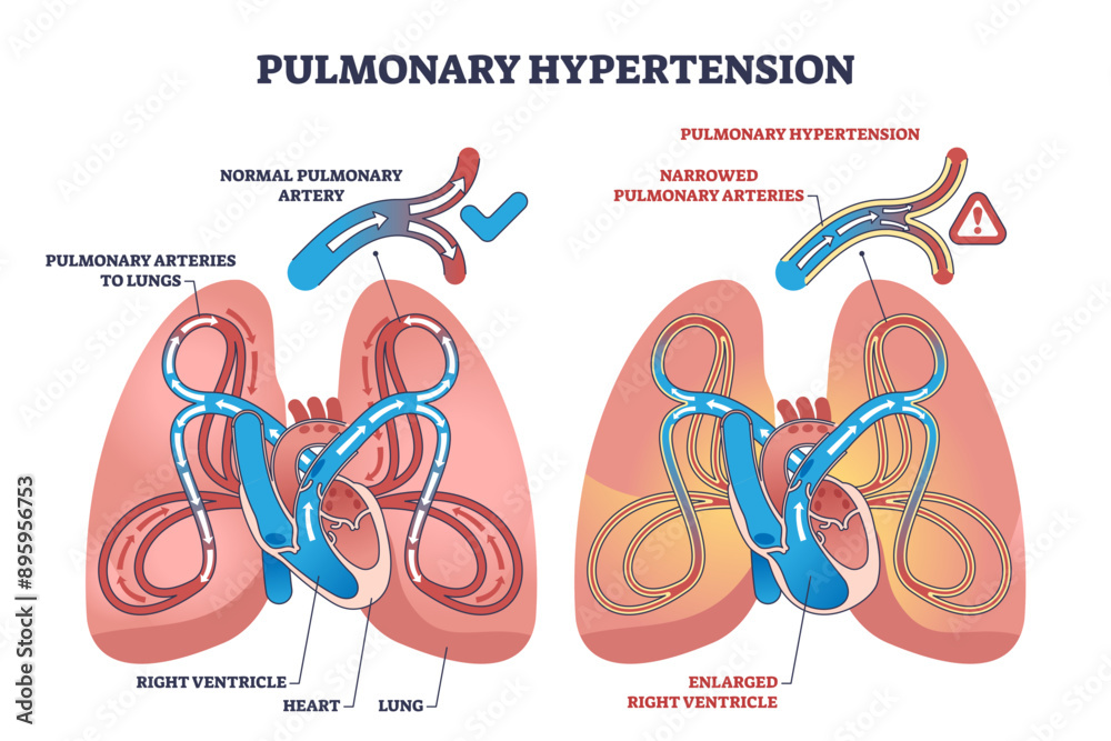 Fotografie Pulmonary hypertension with narrow arteries and blockage outline diagram, transparent background