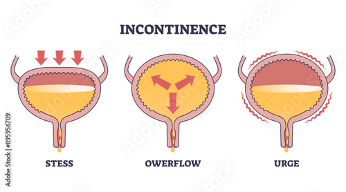 Incontinence problem with stress, owerflow and urge types outline diagram, transparent background. Labeled educational medical disease with uncomfortable urine causes illustration.
