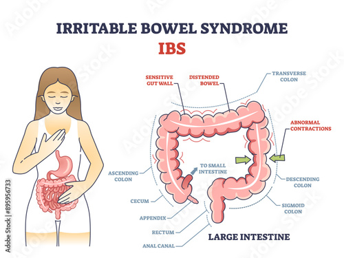 Irritable bowel syndrome or IBS as digestive health problem outline diagram, transparent background. Labeled educational scheme with body gastric tract disease and stomach organ illness illustration.