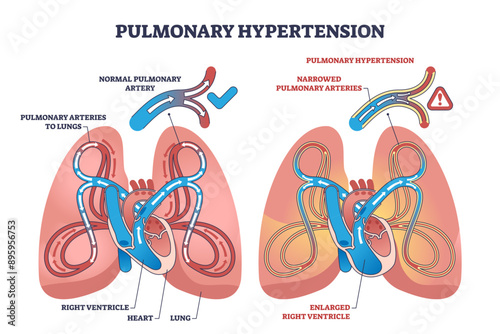Pulmonary hypertension with narrow arteries and blockage outline diagram, transparent background. Labeled educational scheme with medical condition comparison.
