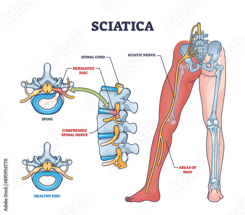 Sciatica as symptom from herniated disc and spinal nerve outline diagram, transparent background. Labeled educational scheme with medical condition from compressed nerves and compared.