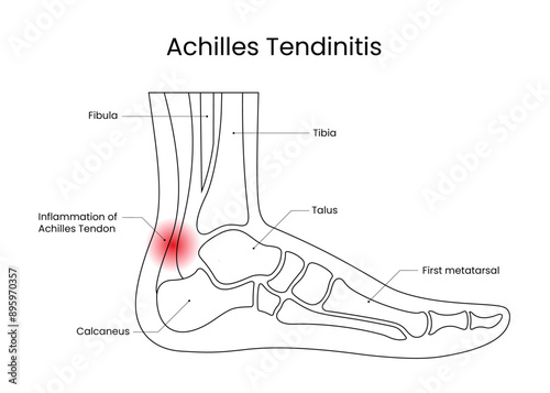 Diagram of Achilles Tendinitis in Line Style
