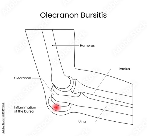 Diagram of Olecranon Bursitis Sketch