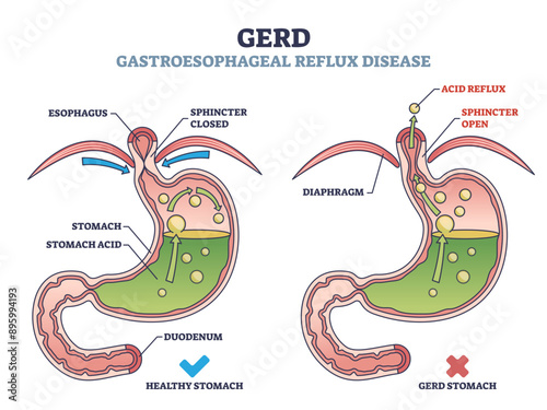 GERD or gastroesophageal reflux disease with digestive acid outline diagram, transparent background. Labeled educational scheme with medical heartburn feeling cause and compared.