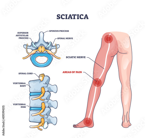 Sciatica areas of pain with anatomical location on leg outline diagram, transparent background. Labeled educational scheme with symptom of medical problem, illness or disease from spinal cord.